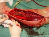 Is Fasciotomy For You? by Dean Ripa